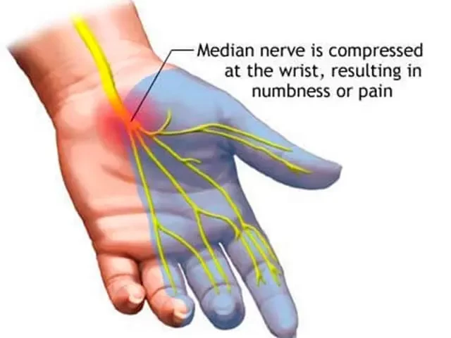 أعراض اختناق عصب اليد الأوسط