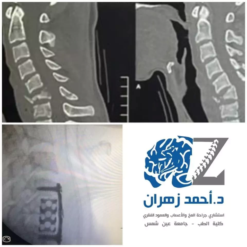 اصلاح كسور الفقرات العنقية