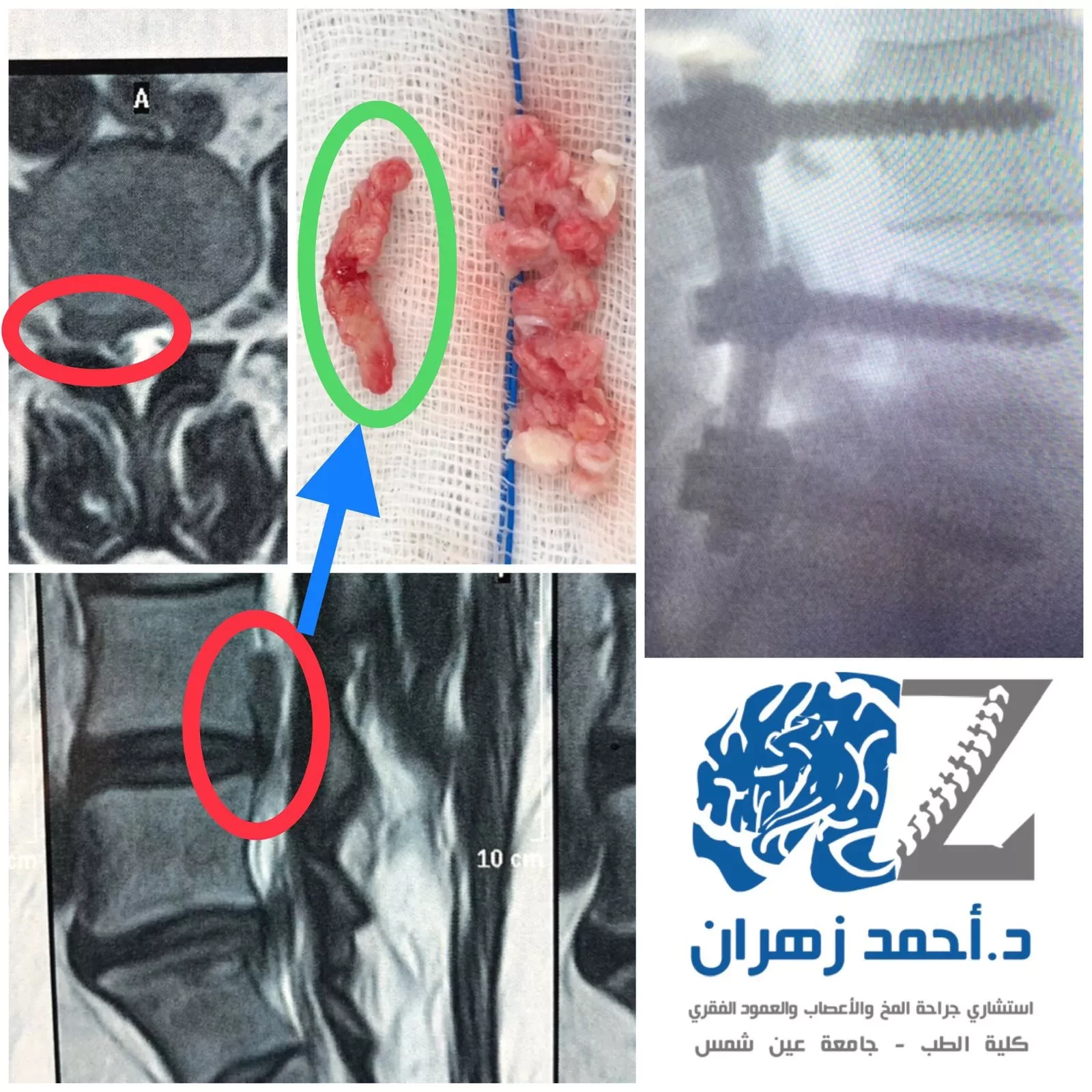 استئصال الانزلاق الغضروفي القطني بالميكروسكوب والمنظار