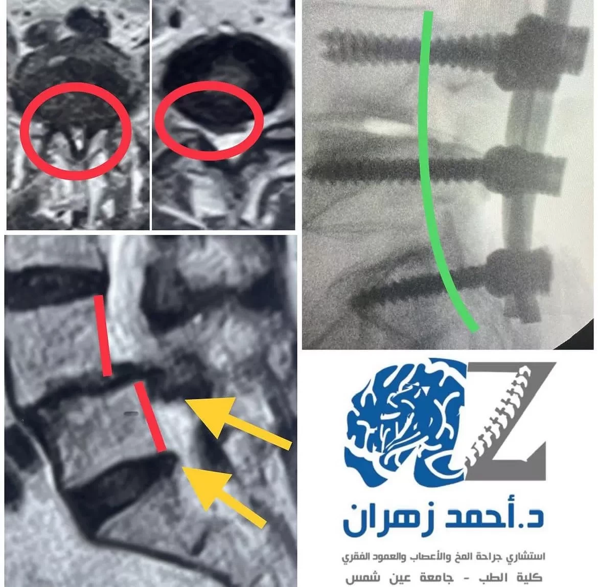 جراحة اصلاح تزحلق الفقرات القطنية بالتثبيت