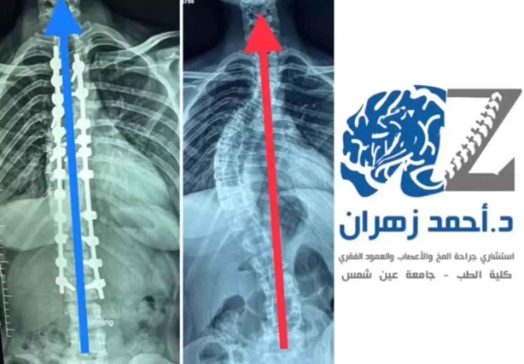 اصلاح اعوجاج و تقوس العمود الفقري (الجنف)